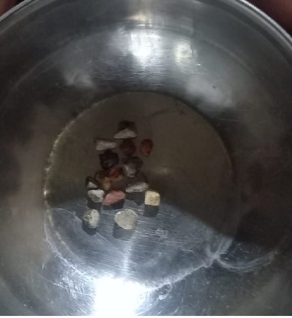 अजीबोगरीब- मुजफ्फरनगर में युवक की आंख से लगातार निकल रहे हैं कंकड़, वीडियो आया सामने